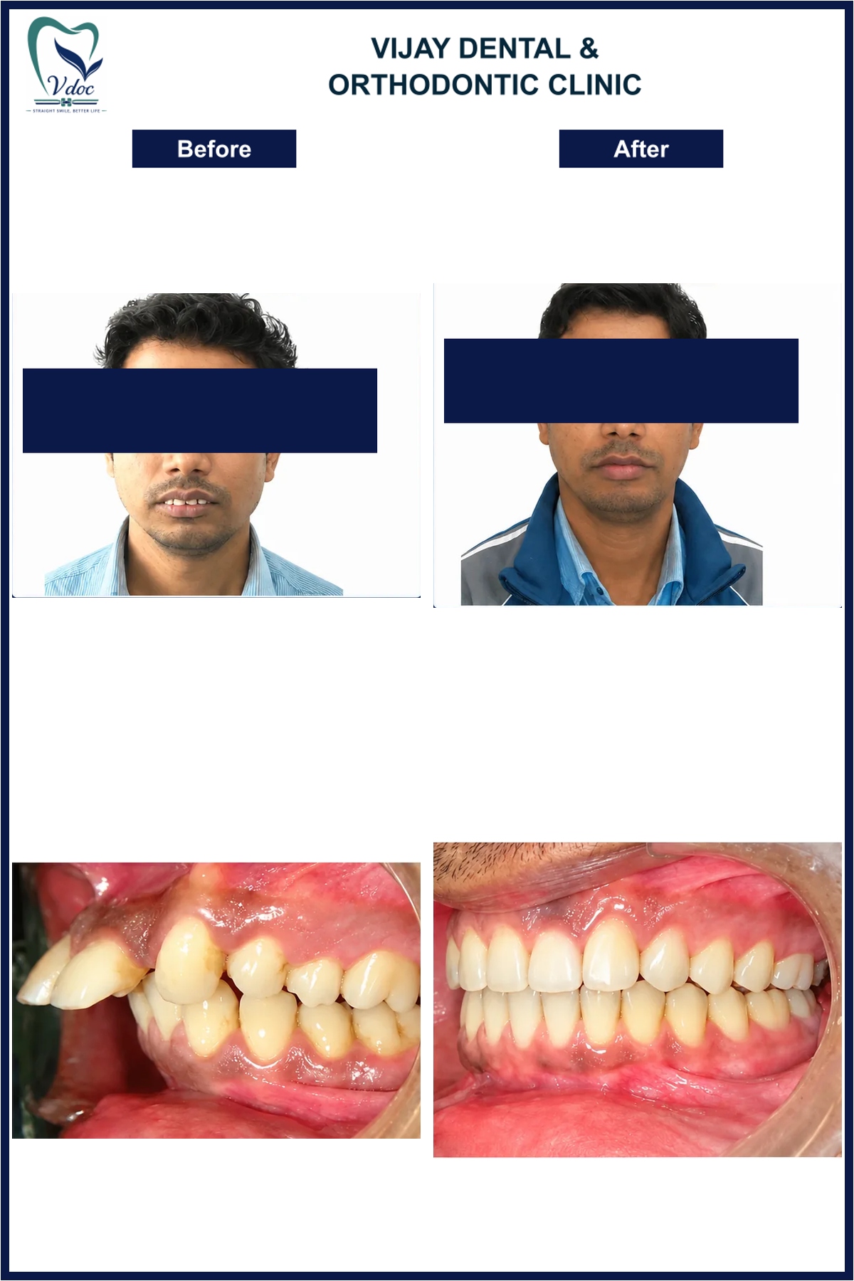 Pre and post class ii malocclusion correction at Vijay Dental and Orthodontic Clinic