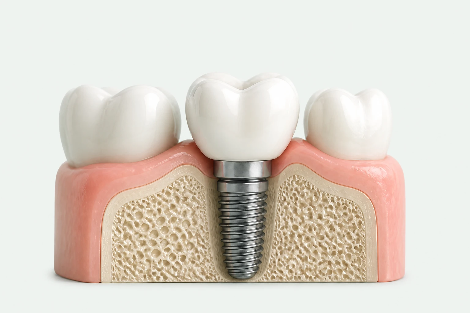 Dental implant and crown illustration